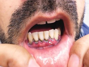 Figuur 2: Burtonse loodzoom van het tandvlees